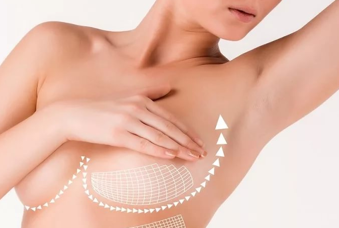 mammoplastica_plast_grudi_6.jpg Маммопластика груди