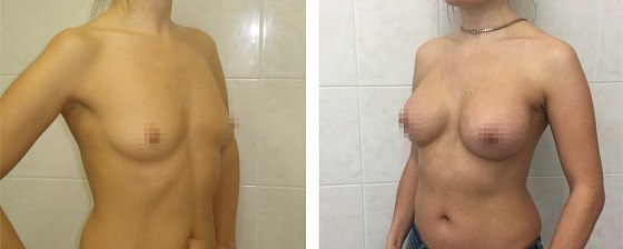 Маммопластика: до и после – фото 51