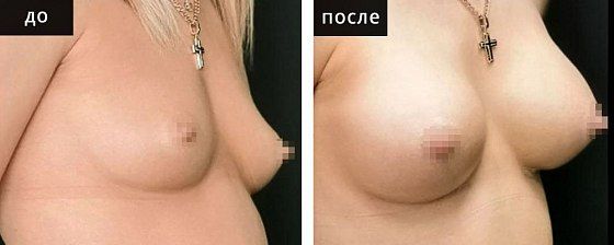 Маммопластика - увеличение груди. Глебова 02: до и после – фото 2