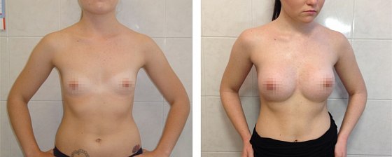 Маммопластика: до и после – фото 54