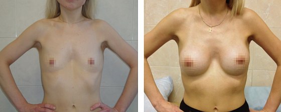 Маммопластика: до и после – фото 56