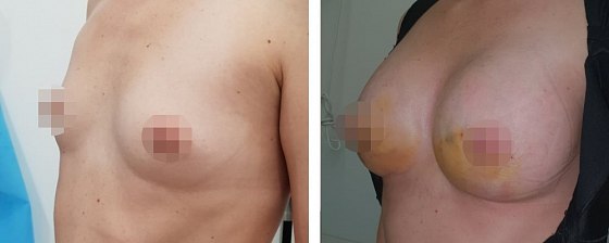 Маммопластика: до и после – фото 2