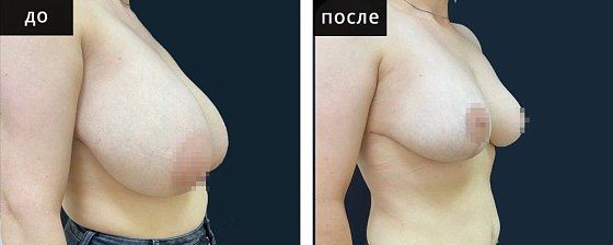 Подтяжка груди. Мурзаева 08: до и после – фото 11