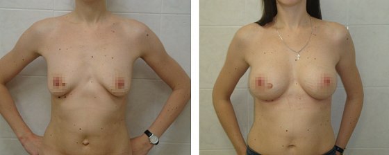 Маммопластика: до и после – фото 44