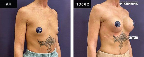Маммопластика: до и после – фото 35