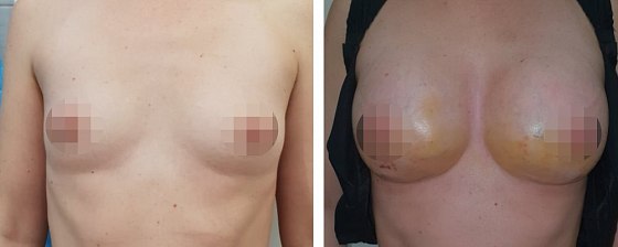 Маммопластика: до и после – фото 1