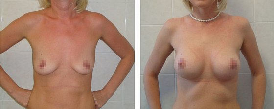 Маммопластика: до и после – фото 46