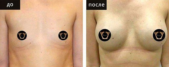 Маммопластика: до и после – фото 12