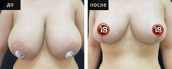 Подтяжка груди. Мурзаева 01: до и после – фото 9