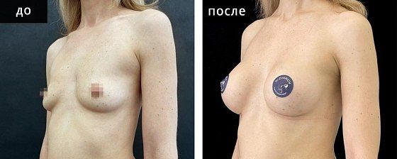 Маммопластика: до и после – фото 29