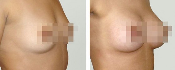 Маммопластика: до и после – фото 48