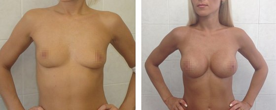 Маммопластика: до и после – фото 57