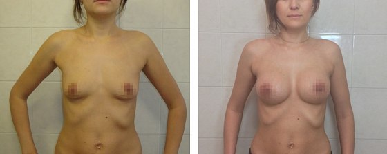 Маммопластика: до и после – фото 55