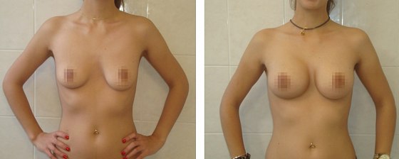 Маммопластика: до и после – фото 47