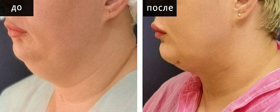 Липосакция шеи. Глебова 02: до и после – фото 2