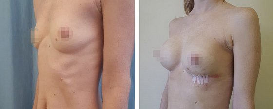 Маммопластика: до и после – фото 3