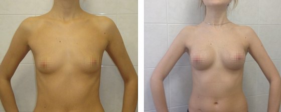 Маммопластика: до и после – фото 52