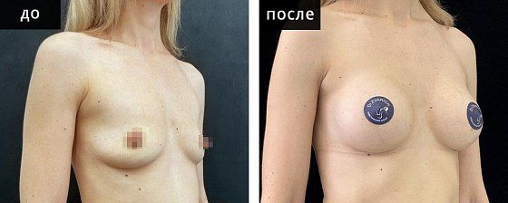 Маммопластика: до и после – фото 27