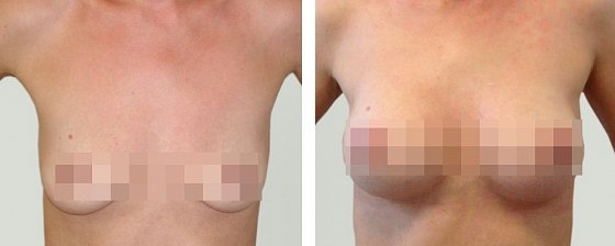 Маммопластика: до и после – фото 58